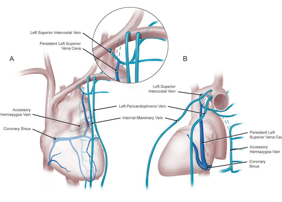 Superior's. Persistent left Superior Vena Cava. Left Superior Vena Cava.